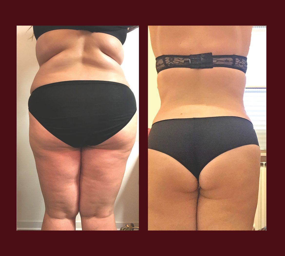Infrabaldan before and after — back