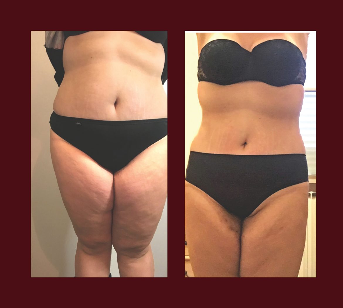 Infrabaldan before and after — front